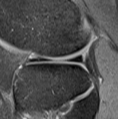 MRI Anterior Lateral Meniscal Tear